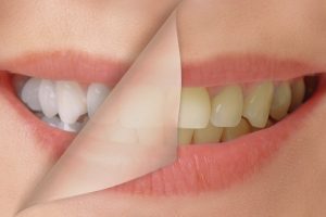 Los 10 mejores blanqueadores dentales